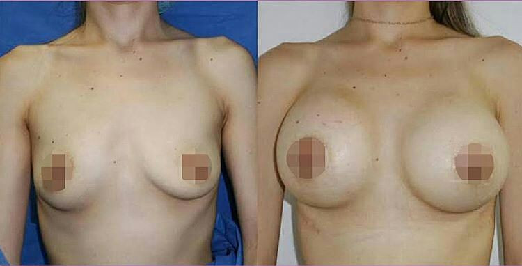 mamoplastia