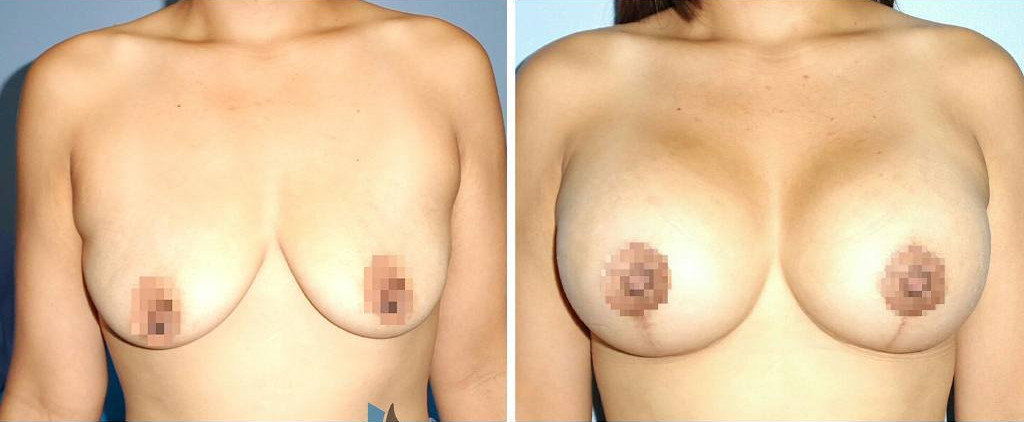 mamoplastia