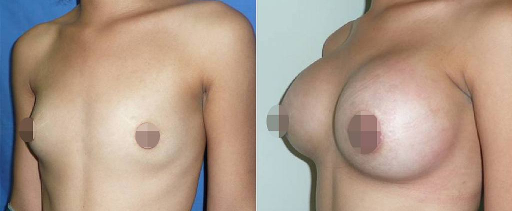 mamoplastia