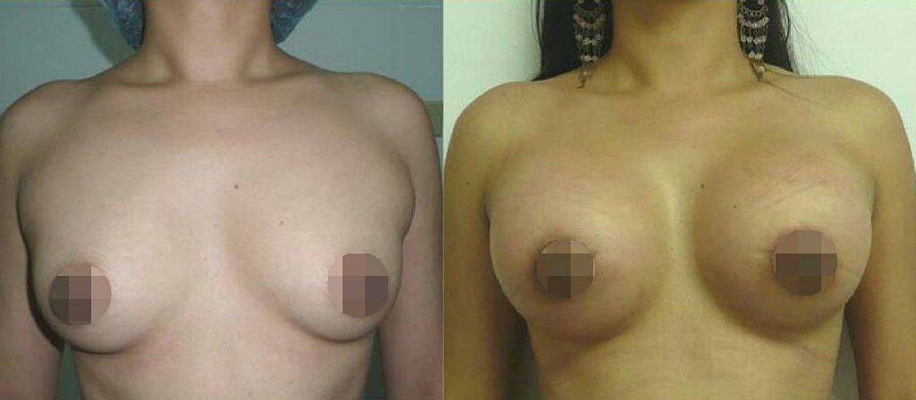 mamoplastia