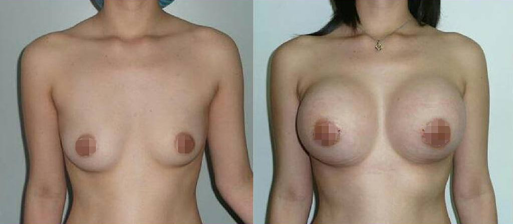 mamoplastia