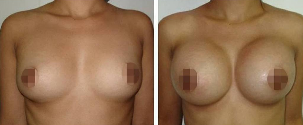 mamoplastia