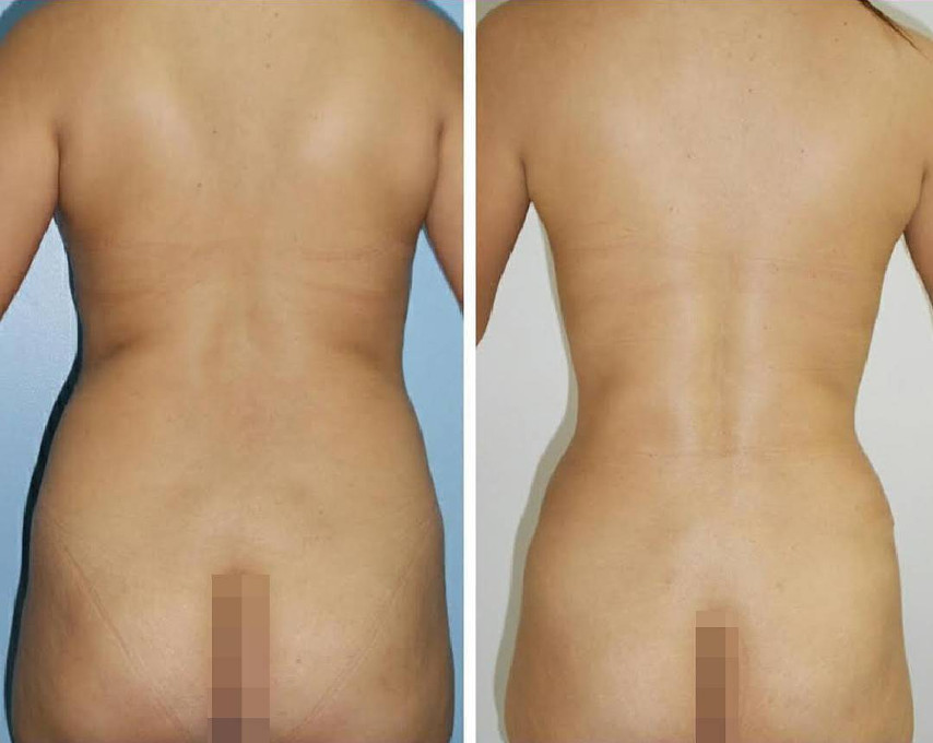 lipo