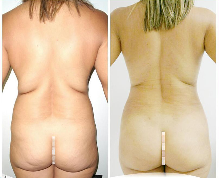 lipo