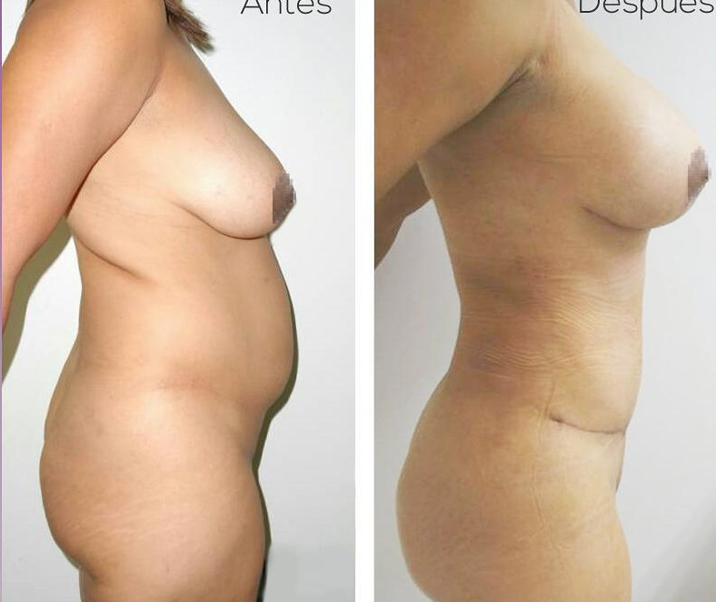 lipo