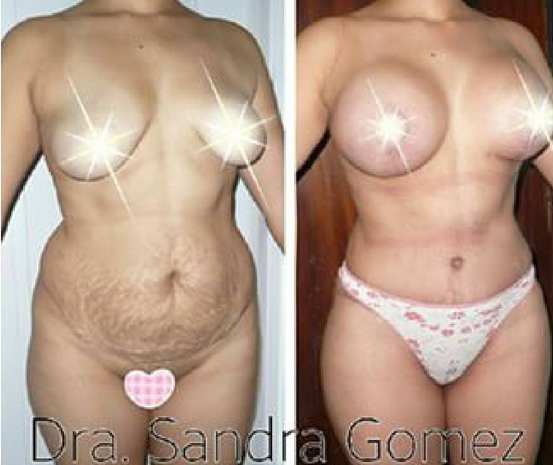 lipo