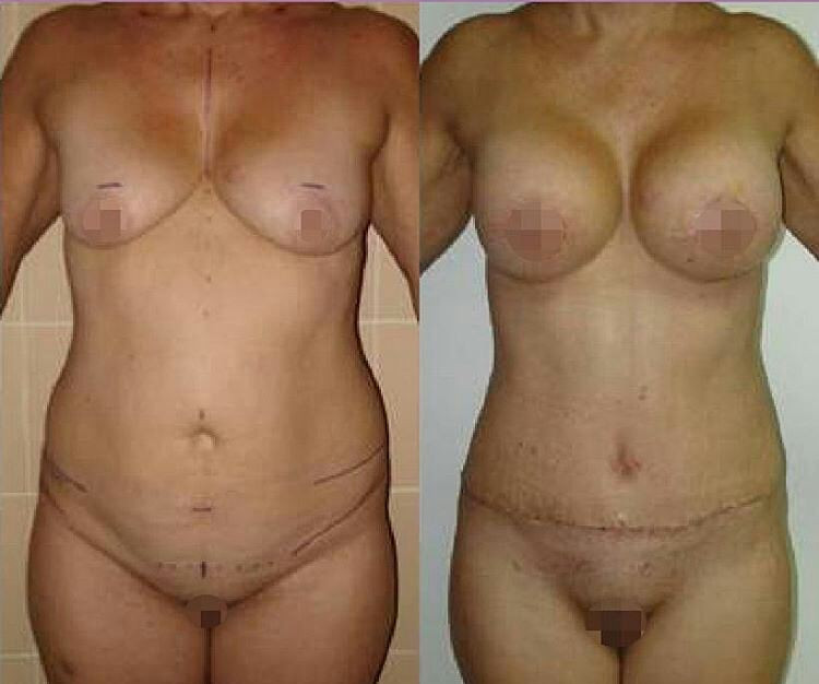 lipo