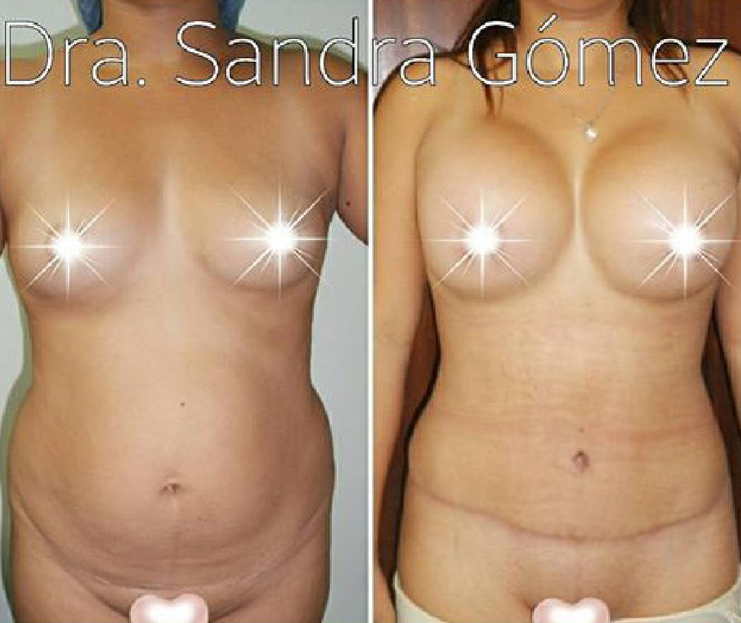 lipo