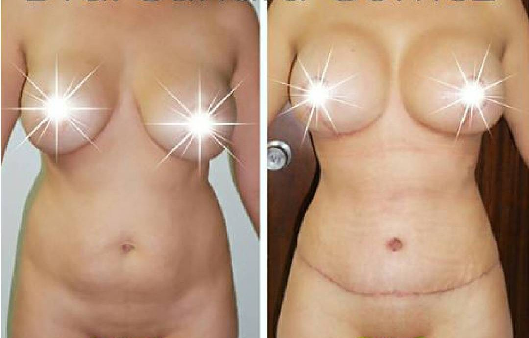 lipo