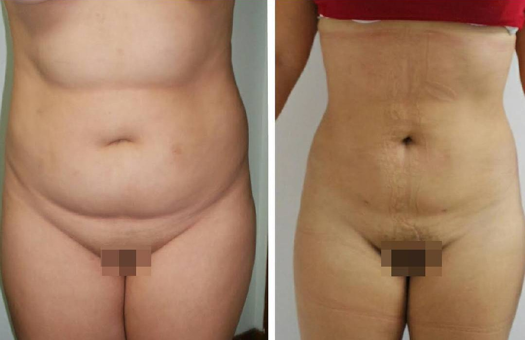 lipo