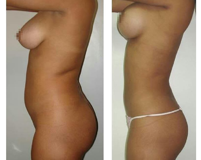 lipo