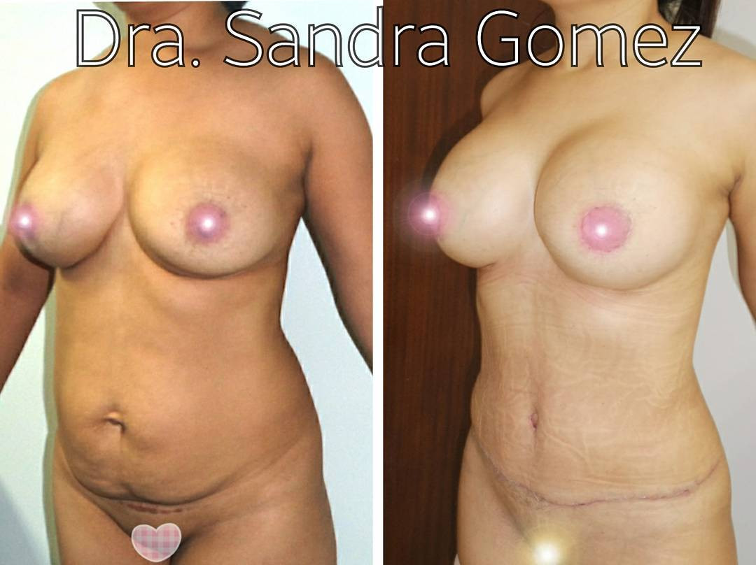 lipo