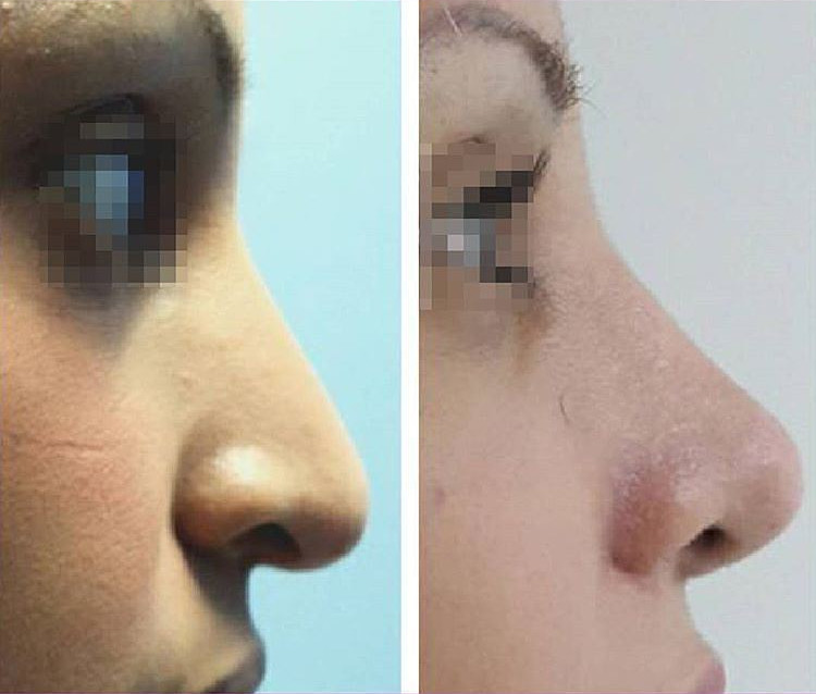 rinoplastia