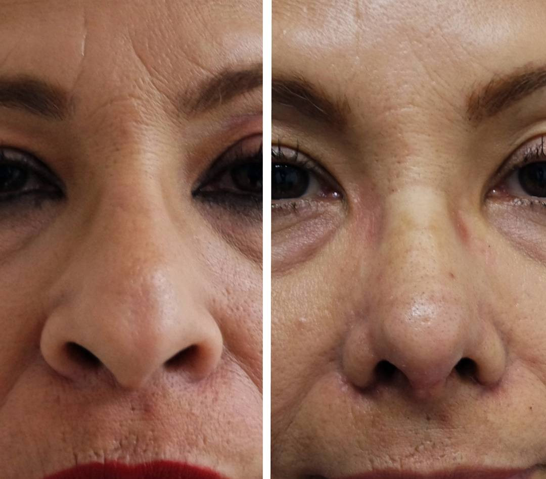rinoplastia