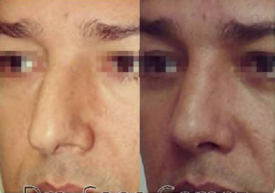 rinoplastia