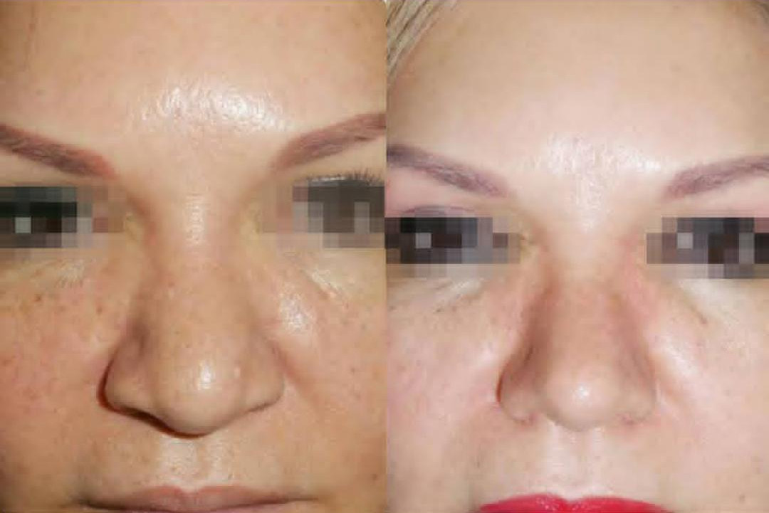 rinoplastia