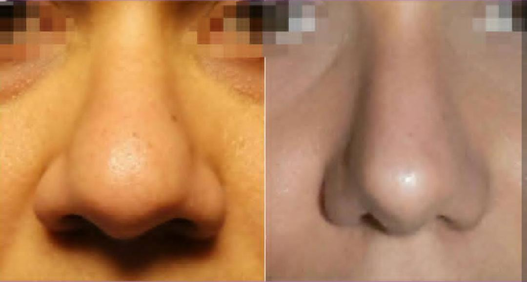 rinoplastia