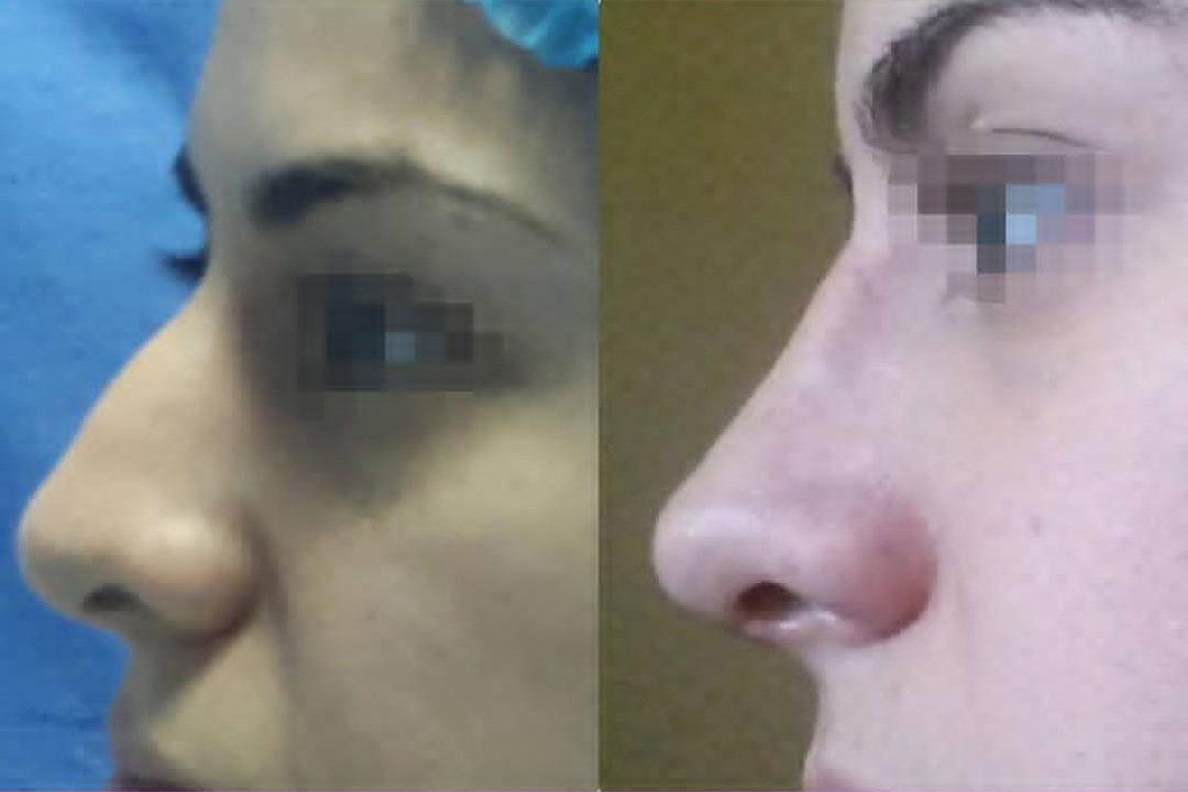 rinoplastia