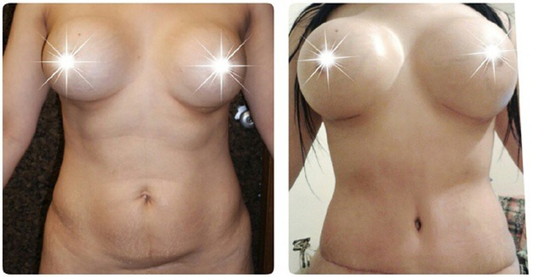 rinoplastia