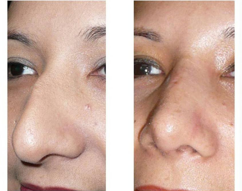 rinoplastia