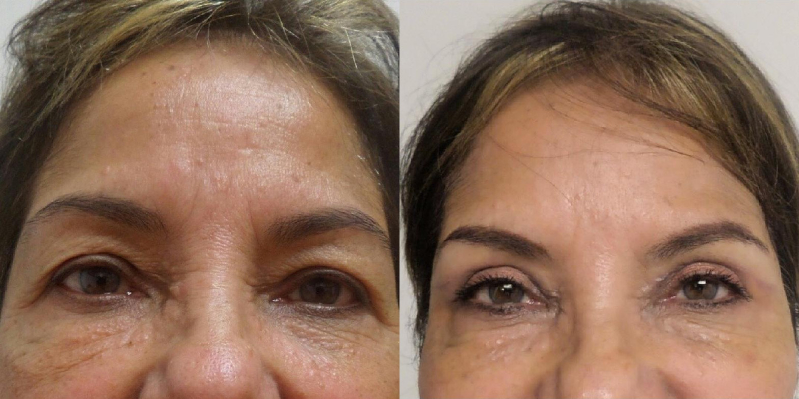 blefaroplastia