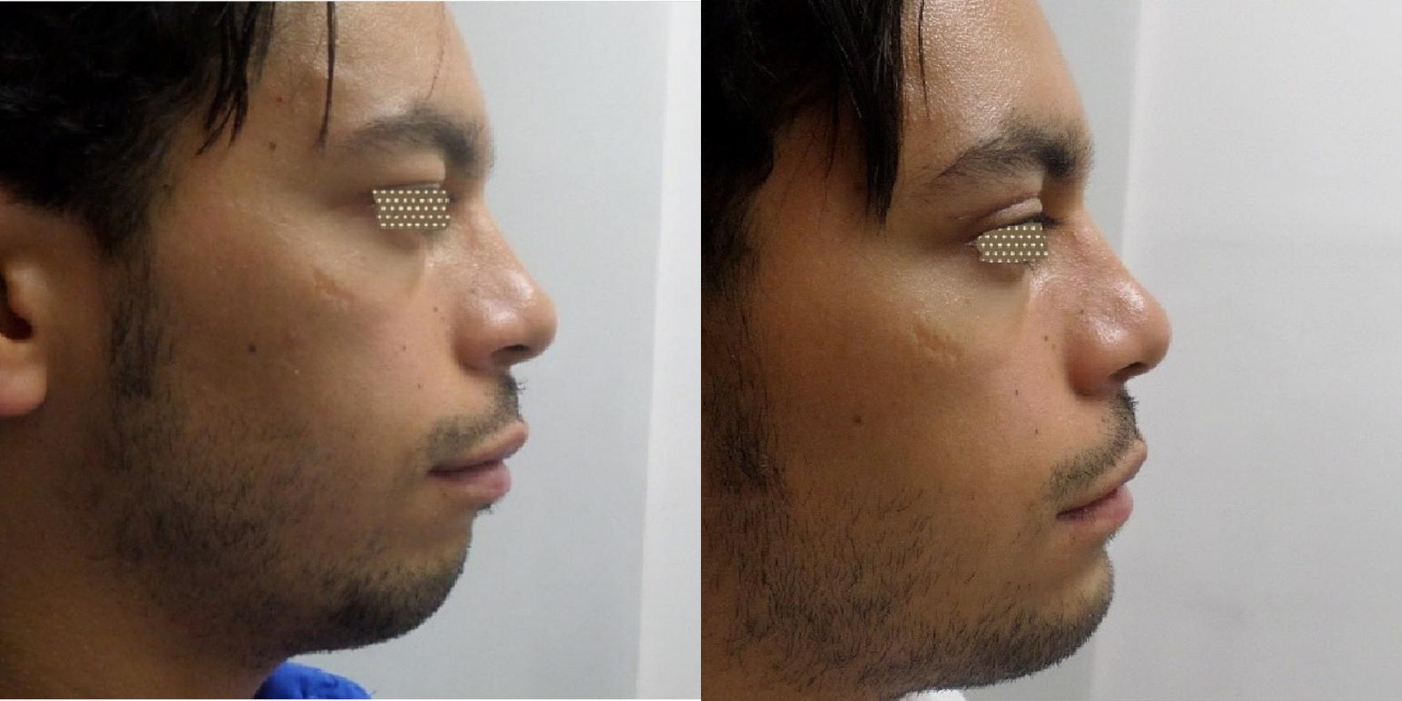 blefaroplastia